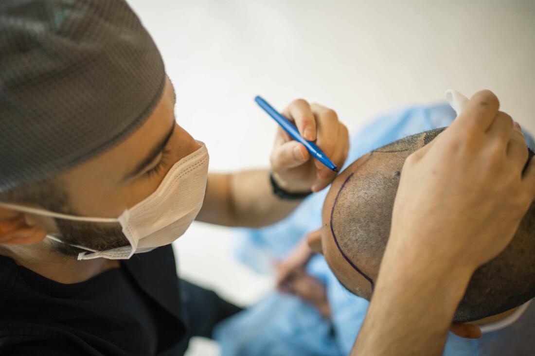 Latest in Hair Transplantation: Combat Hair Loss