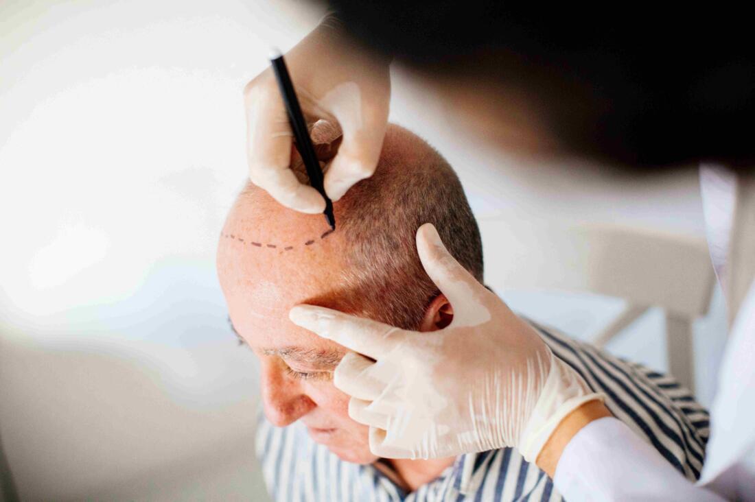 Latest in Hair Transplantation: Combat Hair Loss Image 2