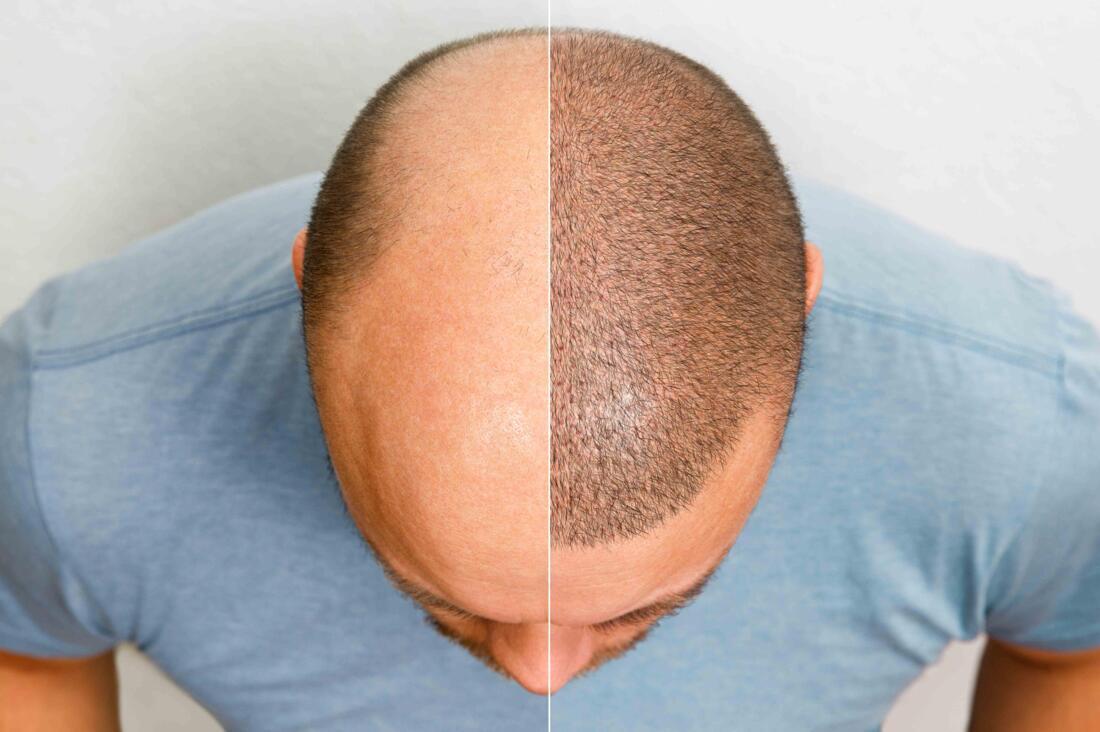 Newest Advancements in Hair Transplantation to Address Hair Loss Image 3